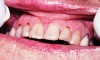 Figure 2  Dental caries is usually seen in cervical and incisal surfaces.