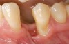 Figure 6  Mucogingival and residual defect after removal of implant in site No. 22.