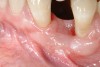 Figure 8  Adequate keratinized and attached gingiva after free gingival graft surgery.