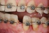 Figure 9  Orthodontic distraction osteogenesis to develop the implant site of tooth No. 23.