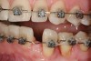 Figure 9  Orthodontic distraction osteogenesis to develop the implant site of tooth No. 23.