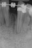 Figure 11  Radiograph showing developed implant site of tooth No. 23.