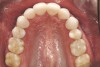 Figure 2f  Teeth Nos. 5 and 12 were converted to Nos. 6 and 11, and Nos. 6 and 11 were converted to Nos. 7 and 10. Nos. 4 and 13 were enlarged. Note stability and absence of orthodontic relapse. Before-and-after smiles.