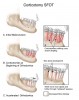 Figure 3  A corticotomy in SFOT is a surgical technique in which only the cortical bone is cut, perforated, or mechanically altered to the depth of the medullary bone and the medullary bone remains intact.