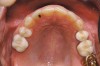 Figure 4a  Corticotomy SFOT. A 42-year-old male presented with a history of extraction orthodontic therapy (A). Incisors were too upright and had severe incisal wear. He was concerned about esthetics of the worn teeth and his insufficient lip support.