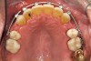 Figure 4b  Progress photo and panorex 9 months after corticotomies were performed on Nos. 6 through 11 (B and C). Previous extraction sites were reopened orthodontically to improve function and fill lip support. Incisal edges were restored provisionally with composite resin. Note that despite the creation of adequate spaces to replace missing teeth, there is inadequate room for placement of dental implants because of severe tipping of all the anterior teeth. Osteotomy SFOT may have been a better choice because it would have allowed needed alveoloskeletal correction (without excessive tipping) instead of the primarily dentoalveolar correction common in corticotomy SFOT. Restorative dentist: Brad Jones, DDS.