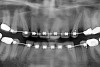 Figure 4c  Progress photo and panorex 9 months after corticotomies were performed on Nos. 6 through 11 (B and C). Previous extraction sites were reopened orthodontically to improve function and fill lip support. Incisal edges were restored provisionally with composite resin. Note that despite the creation of adequate spaces to replace missing teeth, there is inadequate room for placement of dental implants because of severe tipping of all the anterior teeth. Osteotomy SFOT may have been a better choice because it would have allowed needed alveoloskeletal correction (without excessive tipping) instead of the primarily dentoalveolar correction common in corticotomy SFOT. Restorative dentist: Brad Jones, DDS.