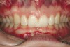 Figure 5c  Note lack of alveolar development from congenitally missing Nos. 24 and 25. Surgical procedures after 5 months of orthodontic alignment included single-tooth osteotomies Nos. 6 to 11 and Nos. 21 to 28 and buccal corticotomies on all other teeth. Anchorage plate was stabilized to piriform rim.