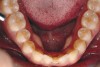 Figure 5d  Note lack of alveolar development from congenitally missing Nos. 24 and 25. Surgical procedures after 5 months of orthodontic alignment included single-tooth osteotomies Nos. 6 to 11 and Nos. 21 to 28 and buccal corticotomies on all other teeth. Anchorage plate was stabilized to piriform rim.