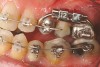 Figure 6c  A 50-year-old female concerned about appearance and bite. Jackscrew appliance was placed after 6 months of orthodontic alignment (A to C).