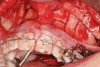 Figure 6d  Figure 6d Patient was missing tooth No. 11 and had A-P and transverse maxillary deficiencies with anterior and left posterior crossbites. Bite was opened with glass ionomer cement. Single-tooth osteotomies were performed on teeth Nos. 6 and 12 and multiple-tooth osteotomies were completed on teeth Nos. 3 to 4, 7 to 10, and 13 to 14.