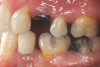 Figure 6h  Jackscrews were activated 0.5 mm/day after 5-day latency period. Note pure translation of segments without tipping. Result 8 months postsurgery. Tooth No. 12 was converted to a canine, and an implant was placed in regenerate bone. Note amount of alveoloskeletal correction and increase in volume of maxillary arch. Also note in Figure 6c and Figure 6c the amount of protraction of maxillary anterior segments while anchorage was maintained in posterior segment. Restorative dentist: Michael E. Carter, DDS.