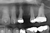 Figure 6i  Jackscrews were activated 0.5 mm/day after 5-day latency period. Note pure translation of segments without tipping. Result 8 months postsurgery. Tooth No. 12 was converted to a canine, and an implant was placed in regenerate bone. Note amount of alveoloskeletal correction and increase in volume of maxillary arch. Also note in Figure 6c and Figure 6c the amount of protraction of maxillary anterior segments while anchorage was maintained in posterior segment. Restorative dentist: Michael E. Carter, DDS.