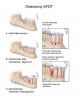 Figure 7  An osteotomy in SFOT consists of surgical cuts through both the cortical and medullary bone and typically indicates the creation of one or more dento-osseous segments.