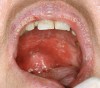 Figure 2b  The same patient had an erythematous hard and soft palate with superimposed white candidal plaques.