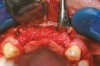 Figure 5  Re-entry 6 months postsurgery revealed a notable increase in the dimensions of the ridge.