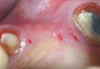 Figure 7  Occlusal view before flap reflection.