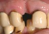 Figure 11  Blunt trauma to the patient’s face evulsed the right central incisor and damaged the facial plate.