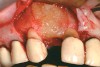 Figure 13  RegenerOss Allograft Putty adapted to the ridge.