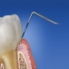 Figure 1  Probing depth of < 3 mm, with the tip of the probe coronal to the junctional epithelium in healthy gingiva.