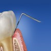 Figure 2  Probing depth of 6 mm, with the tip of the probe apical to the coronal attachment of the junctional epithelium in inflamed gingival tissue.