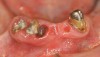 Figure 4a  Hopeless mandibular arch. Teeth Nos. 27, 26, 25, and 22 are present.