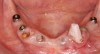 Figure 4b  Example of a SEP C1. Teeth Nos. 26 and 25 were extracted. All implants were placed at the same time at site Nos. 28, 29, 26, 23, 21, and 20. A temporary stainless steel post was placed into tooth No. 27 to help retain the provisional prosthesis. The provisional prosthesis was supported by teeth Nos. 22 and 27. (Photo was taken 3 months after implant insertion.)