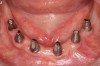 Figure 4c  Teeth Nos. 22 and 27 were extracted 3 months after initial implants were placed. At that time a provisional fixed appliance was placed on implant Nos. 28, 29, 26, 23, 21, and 20. This photo demonstrates abutments in place, 6 weeks after teeth Nos. 22 and 27 were extracted.