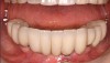 Figure 4d  Final mandibular prosthesis extended from teeth Nos. 29 through 20.