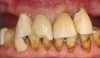 Figure 5a  Hopeless maxillary arch. Teeth Nos. 7 through 10 and 14 are present.