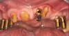 Figure 5b  At the first round of implantation, implants were placed at site Nos. 4, 5, 6, 9, 12, and 13. The provisional prosthesis was supported by teeth Nos. 7, 8, 10, and 14.