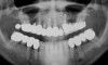 Figure 6  Panoramic radiograph of case used to illustrate some variations of serial extraction protocols.