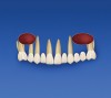 Figure 7b  Sinus lifts will be performed on maxillary right side and, 1 month later, on the left side. The ovals in the diagram over teeth indicate a sinus lift was performed. The sinus lifts are allowed to heal for 9 months.