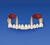 Figure 7c  A provisional prosthesis is placed on teeth Nos. 3 through 14 after extractions of teeth Nos. 5, 8, and 9. Teeth Nos. 3, 6, 11, and 14 support the provisional prosthesis.