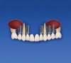 Figure 7e  The provisional is replaced on teeth Nos. 3 through 14. Teeth Nos. 3, 6, 11, and 14 support the provisional prosthesis.
