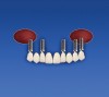 Figure 7g  The provisional prosthesis is altered and placed on teeth Nos. 5 through 13. Implant sites Nos. 5, 7, 10, 12, and 13 support the provisional prosthesis.