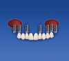 Figure 7i  The provisional prosthesis is replaced on teeth Nos. 5 through 13. Implant sites Nos. 5, 7, 10, 12, and 13 support the prosthesis.