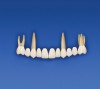 Figure 8c  The provisional prosthesis is placed on teeth Nos. 3 through 14. Teeth Nos. 3, 6, 11, and 14 support the provisional prosthesis.