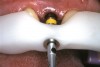 Figure 4  Photographic descriptions of dental procedures before restorative treatment can improve patient awareness, informed consent, treatment acceptance, and the patient/clinician relationship.