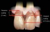 Figure 2  Between natural teeth, the average osseous scallop is 3 mm from the facial to the interproximal, and the average gingival scallop is 4.5 mm from the facial to the interproximal.