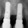 Figure 8  Maintenance of interproximal crestal bone following final restoration placement.