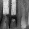 Figure 10  In these adjacent implants placed in the central and lateral positions, note the excellent interproximal bone but minimal interimplant distance.