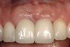 Figure 24  Minimal gingival scallop because of the apically placed papilla and a long contact is the expected outcome in a patient with significant interproximal bone loss before implant placement.