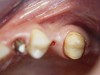 Figure 2  Preoperative view of the area around tooth No. 24. On the left, a previously placed implant abutment is visible.