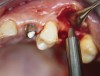 Figure 3a  Alternating osteotomes with variable conicity used to perform the alveolar remodeling in the area of tooth No. 24.