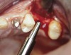 Figure 3b  Alternating osteotomes with variable conicity used to perform the alveolar remodeling in the area of tooth No. 24.