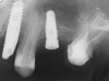 Figure 4  Implant positioning; the radiograph taken 4 weeks after placement confirmed good primary stability.