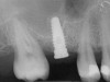Figure 8  At 4 months after treatment, the radiograph revealed the presence of a bone layer surrounding the implant.