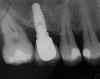 Figure 10  Posttreatment radiograph, after cementation of the final restorations.