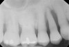 Figure 2  Same case as in Figure 1 after 1.5 years with no treatment. At that time, the bone loss affected the adjacent teeth. The apical extent of the bone loss was approximately 5 mm from the sinus floor.